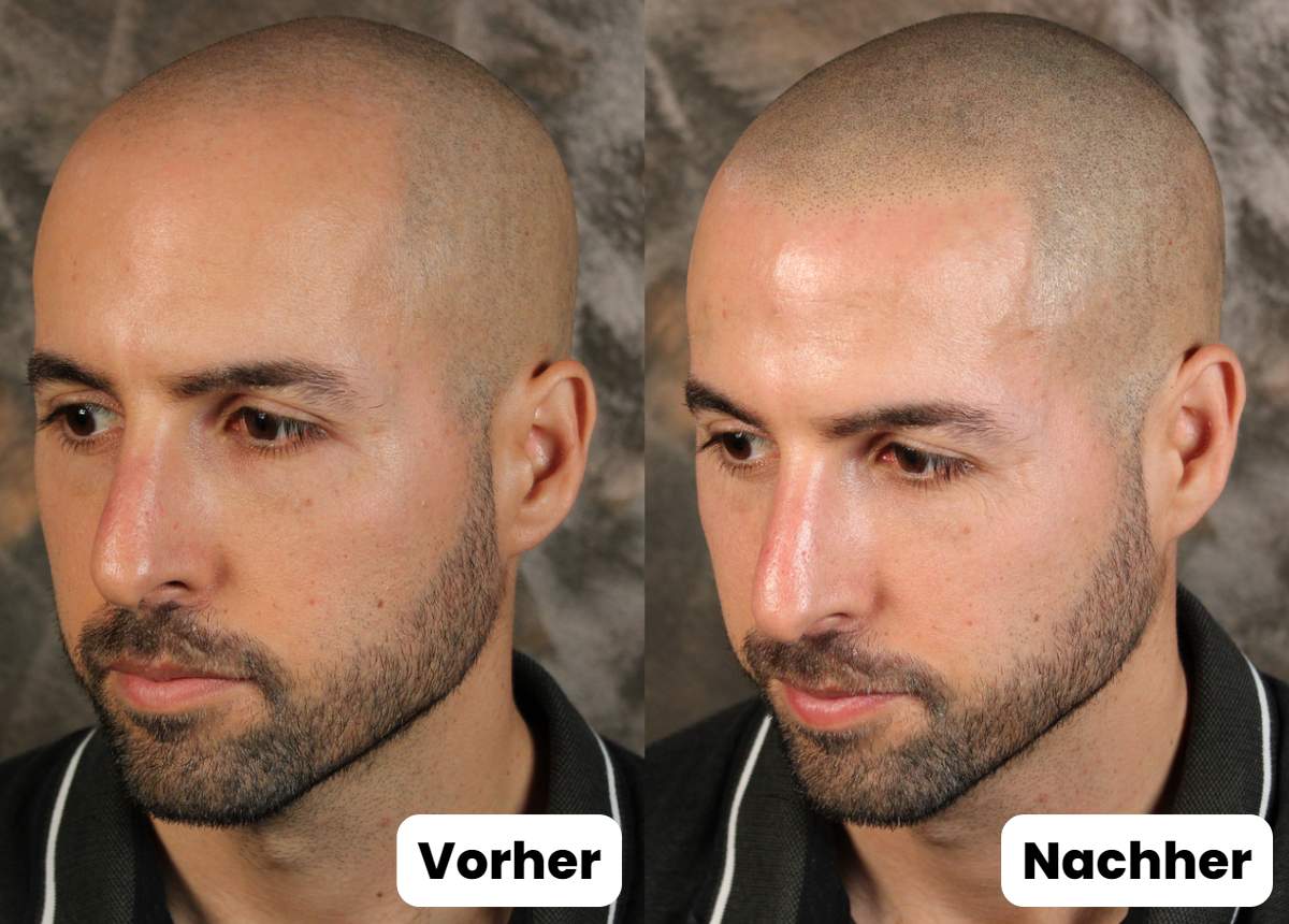 Vorher nachher Scalpline Haarpigmentierung anstatt haartransplantation