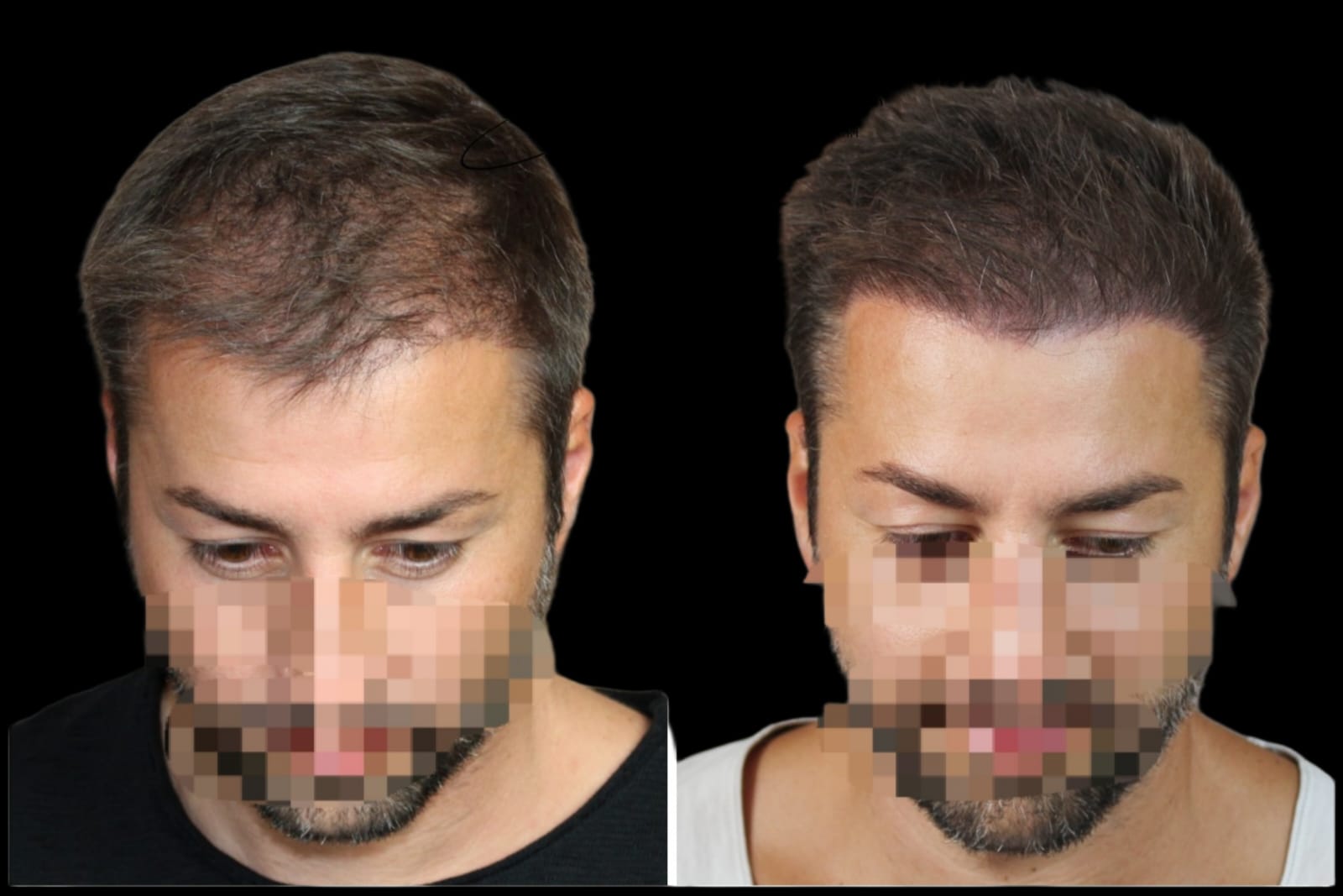 Vergleich Transplantation und Pigmentierung